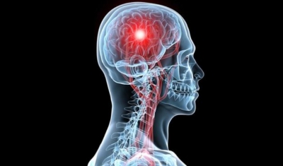 Türkiye’de Her Yıl 200 Bin Kişi İnme Geçiriyor